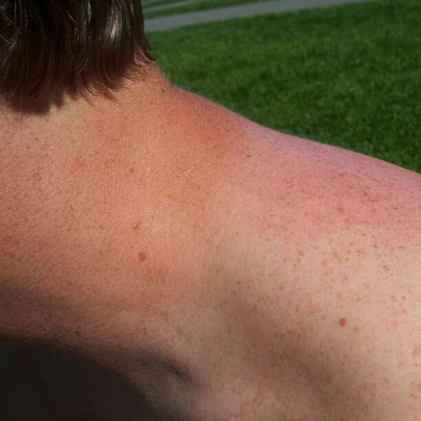 Instagram: Three shades of sunburn